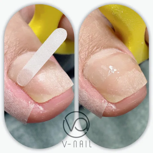 V-Nail